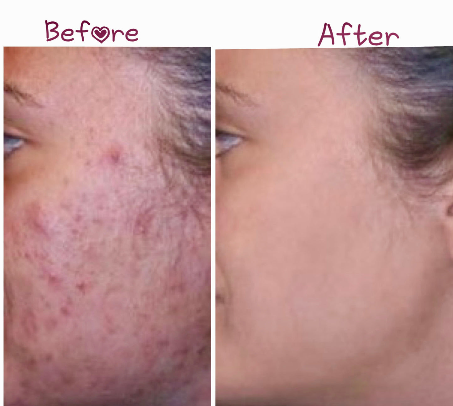 Acne Repair Sulfur Soap